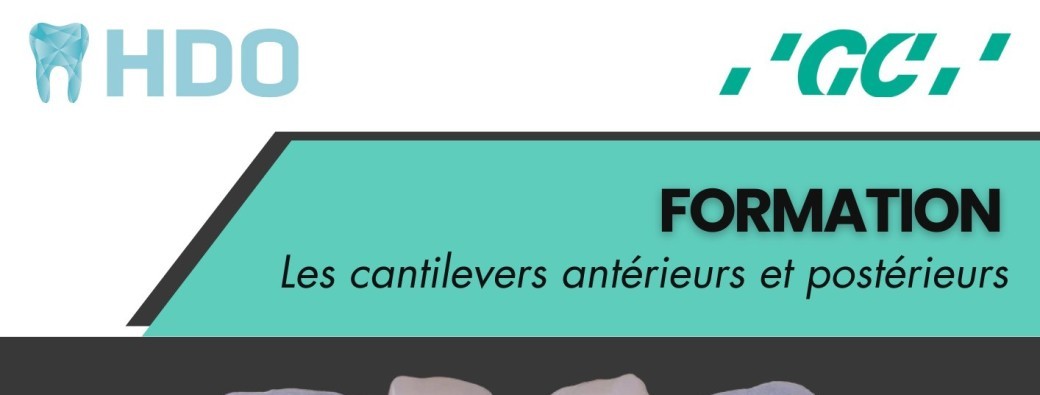 Les cantilevers antérieurs et postérieurs